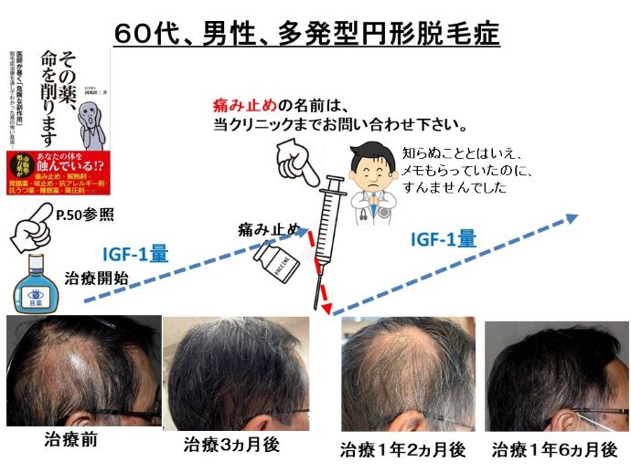 円形脱毛症　病院